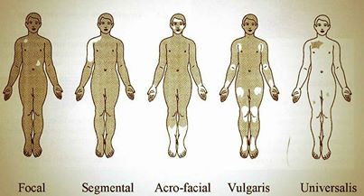 types-vitiligo